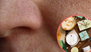 8 засобів, щоб зменшити розширені пори