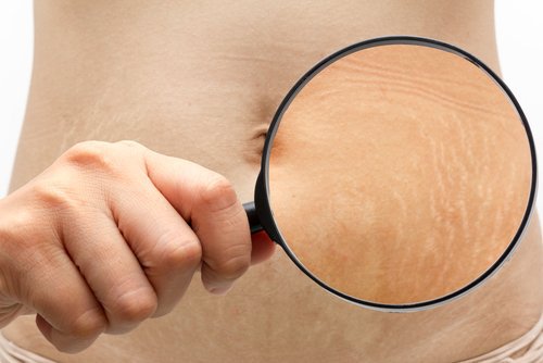 6 порад для зменшення та усунення розтяжок