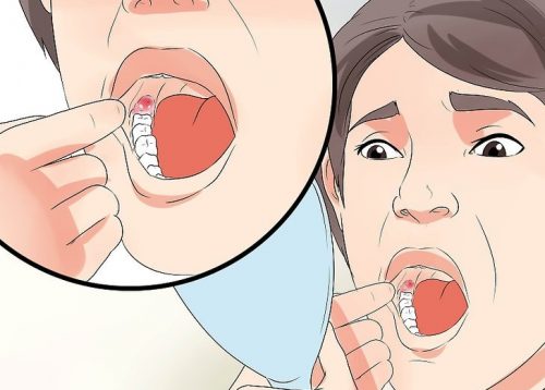 Як зменшити набряк після видалення зубів мудрості