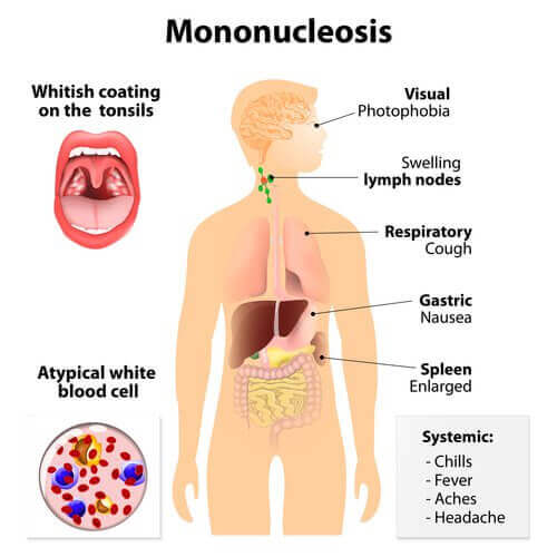інфекційний мононуклеоз