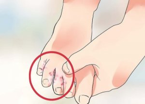 Натуральні засоби від грибкового захворювання ніг