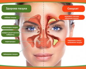 Симптоми синуситу: від розвитку до діагностики