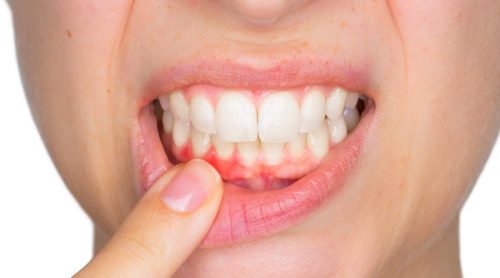гнійні виділення при зубних інфекціях