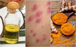 Запалення волосяних фолікулів: 5 домашніх засобів