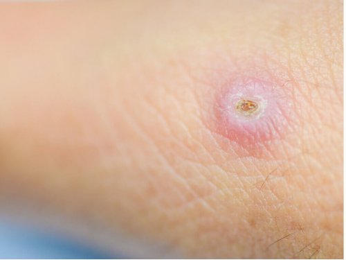 причини формування фурункулів