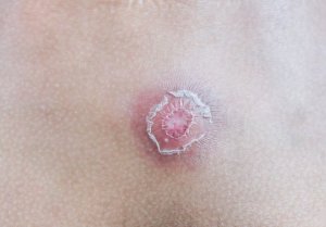 Сім способів позбутися фурункулів