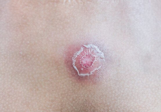 Сім способів позбутися фурункулів