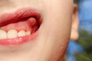 Як лікувати зубний абсцес 10 домашніми засобами