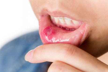як запобігти стоматиту і виразкам у роті 