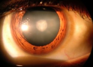 8 фактів, які варто знати про катаракту