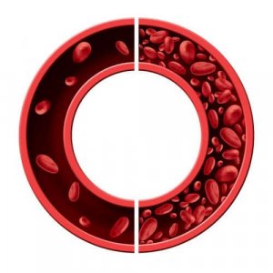 Лікування залізодефіцитної анемії: 5 природних засобів