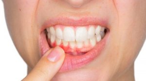 Зубні абсцеси та способи їх лікування