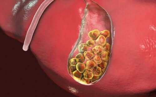 що таке жовчні камені