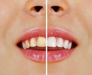 Натуральні засоби для відбілювання зубів