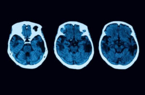 Атрофія головного мозку: діагностика та лікування
