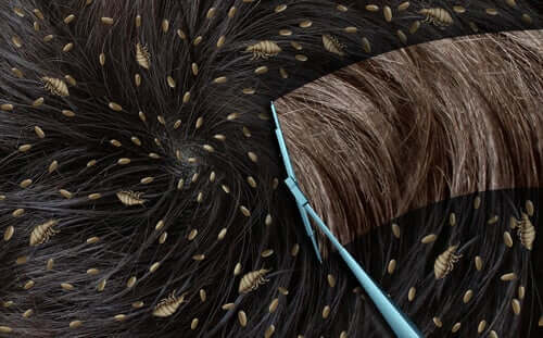 як позбутися від гнид