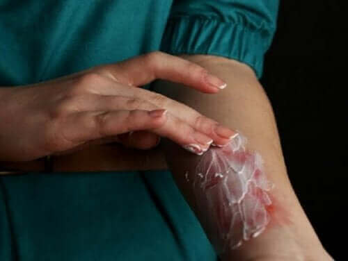 мазь при опіках