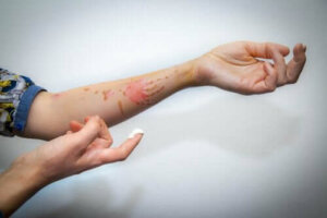 Як загоїти поверхневі опіки природним шляхом?