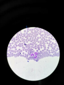 Агранулоцитоз: симптоми та лікування