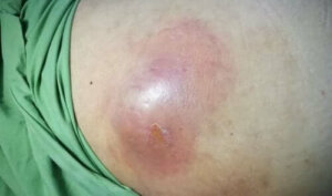 Що таке внутрішньочеревний абсцес?