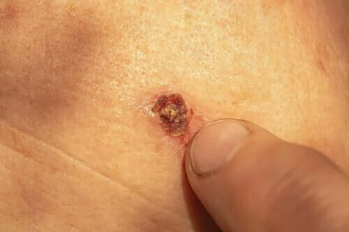 бородавки кровоточать