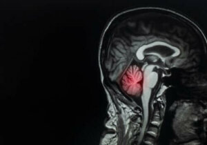 Метастази в мозку: опис та лікування