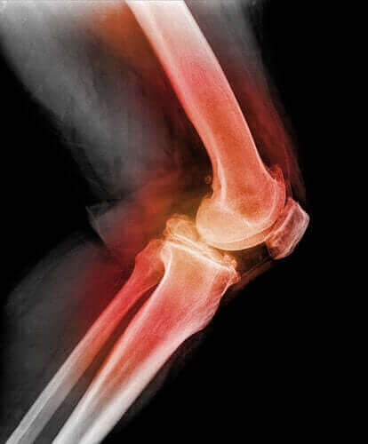 Дізнайтеся все про вивих колінної чашечки