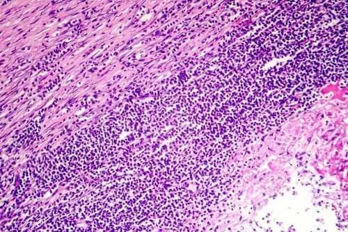 види перикардиту